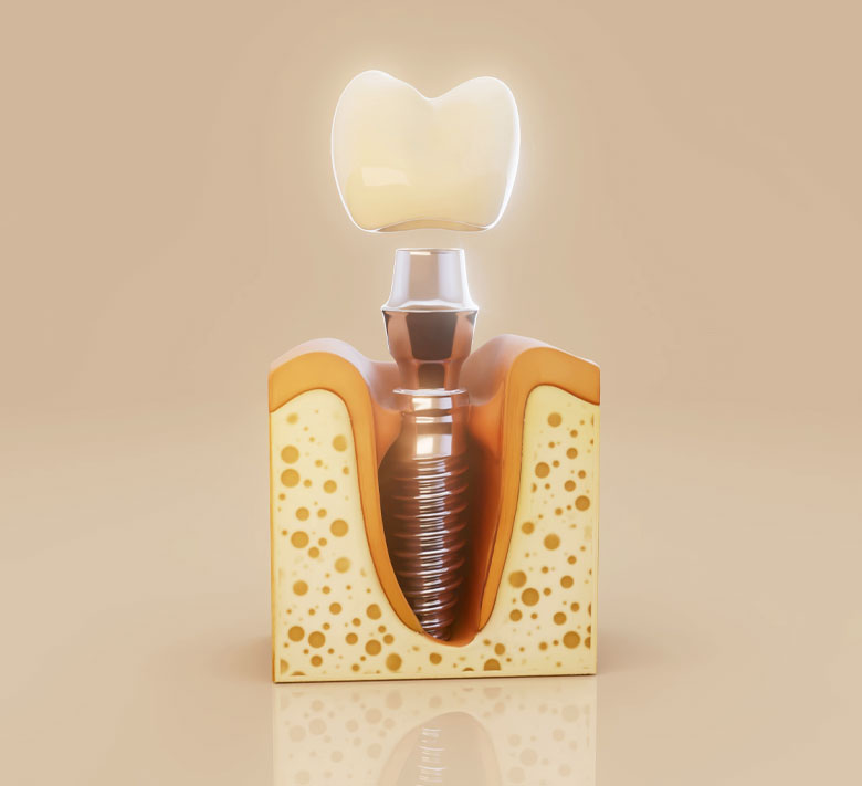 implantes dentales en santo domingo